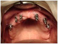 cheap dental implant in dubai