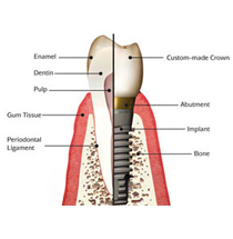 dental implant clinic dubai S8