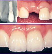 dental implant clinic in dubai S7