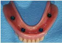 dental implant treatment in jlt