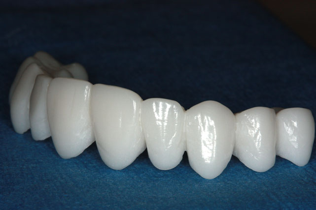 dental implant in uae