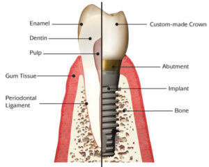 Dental Implant Anatomy