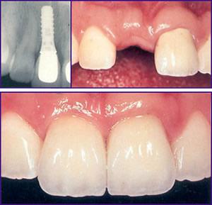 single tooth implant in Dubai UAE