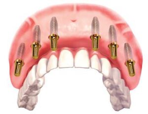 dental implant clinic in dubai UAE