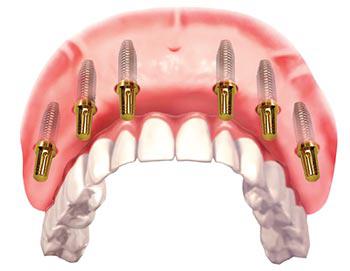 dental implant clinic in dubai UAE