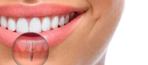 Who is a perfect candidate for dental implants?
