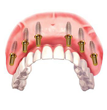 dental implant clinic in dubai S6