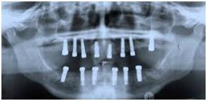 full mouth dental implant in dubai pic