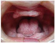 teeth implants dubai