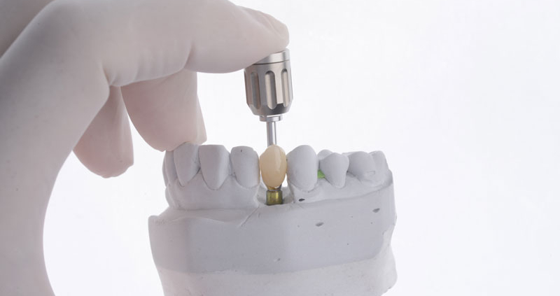 Dental implant crown placement at Dr. Thomas Dental Implant Clinic in Dubai demonstrating affordable high-quality dental implant treatment