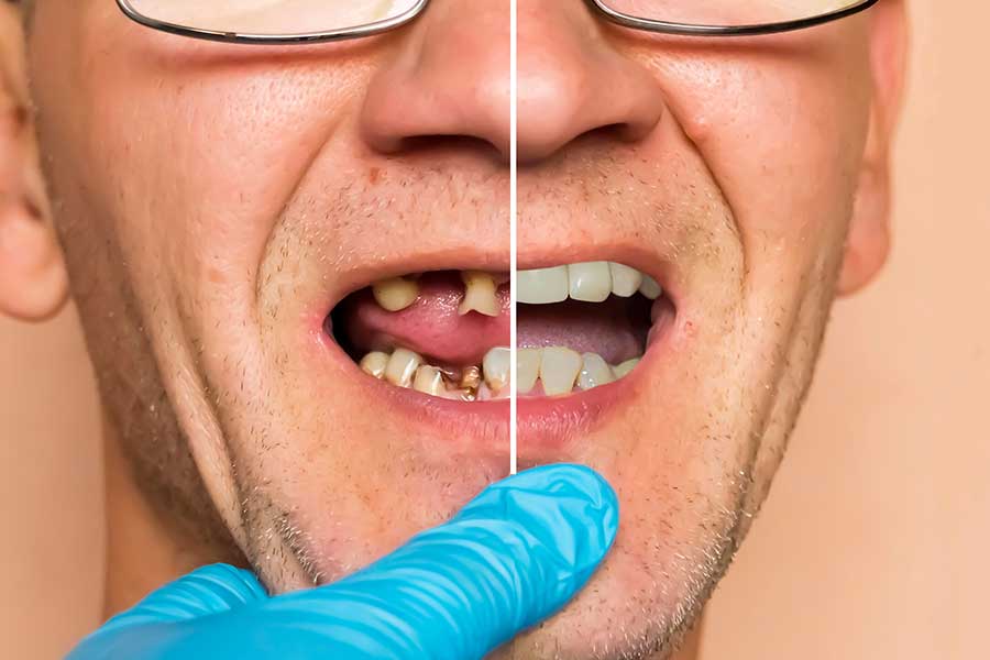 Dental implants solution for multiple missing teeth in Dubai showing before and after smile restoration