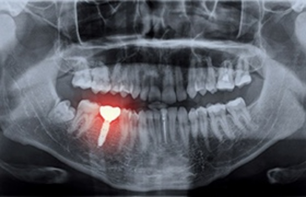 Dental X-ray showing a failing dental implant with inflammation around the implant post indicating possible peri-implantitis and bone loss treated at Dr. Thomas Dental Implant Clinic in Dubai.